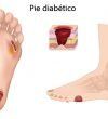 Pie diabético, qué consejos seguir