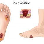 Pie diabético, qué consejos seguir