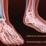 Qué es la neuropatíi diabetica y como tratarla